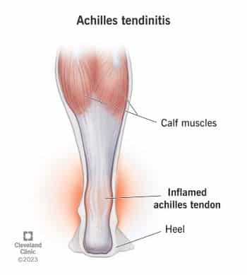 Achilles Tendonitis